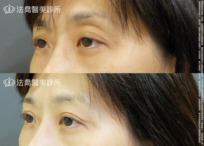 法喬醫美診所,邱浚彥,自體脂肪豐臉,割雙眼皮,眼窩補脂