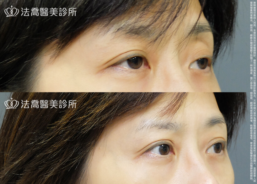 法喬醫美診所,邱浚彥,自體脂肪豐臉,割雙眼皮,眼窩補脂