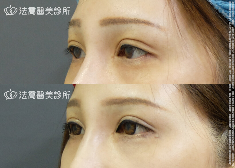 法喬醫美診所,邱浚彥,自體脂肪豐臉,割雙眼皮,眼窩補脂