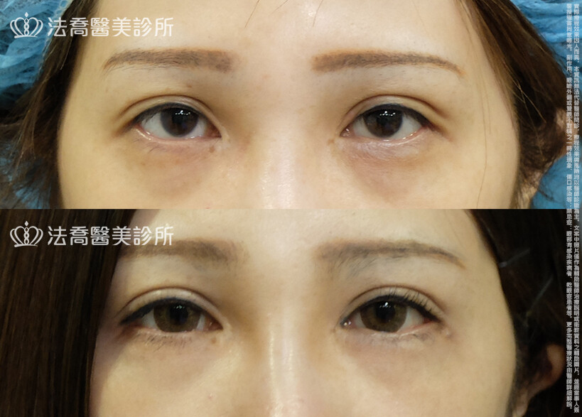 法喬醫美診所,邱浚彥,自體脂肪豐臉,割雙眼皮,眼窩補脂