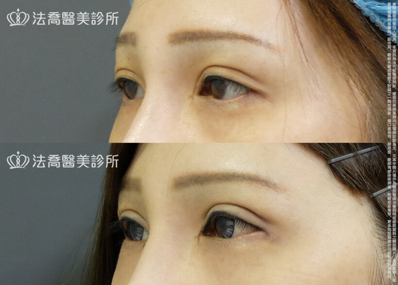 法喬醫美診所,邱浚彥,自體脂肪豐臉,割雙眼皮,眼窩補脂