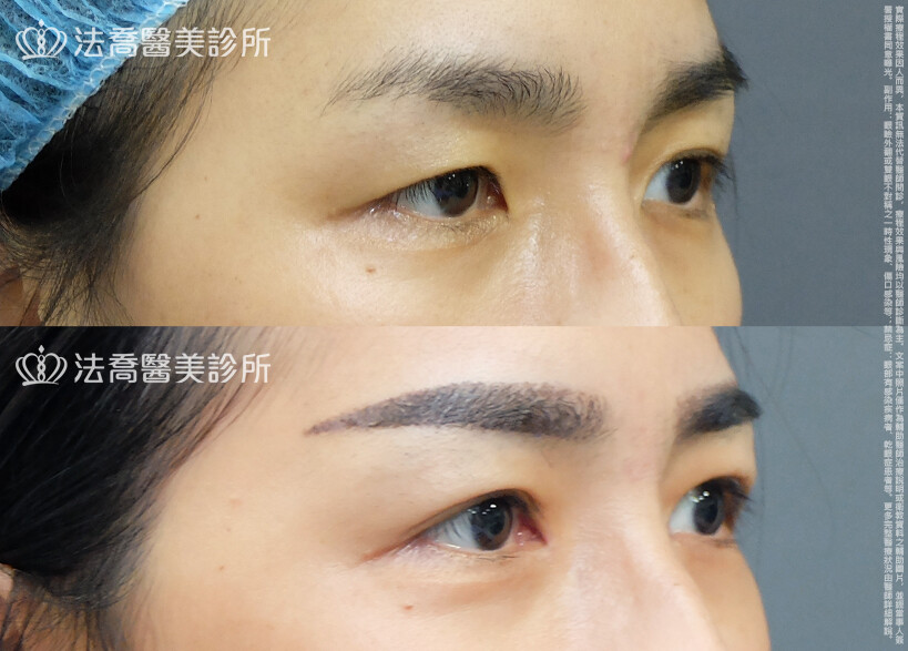 法喬醫美診所,邱浚彥,自體脂肪豐臉,割雙眼皮