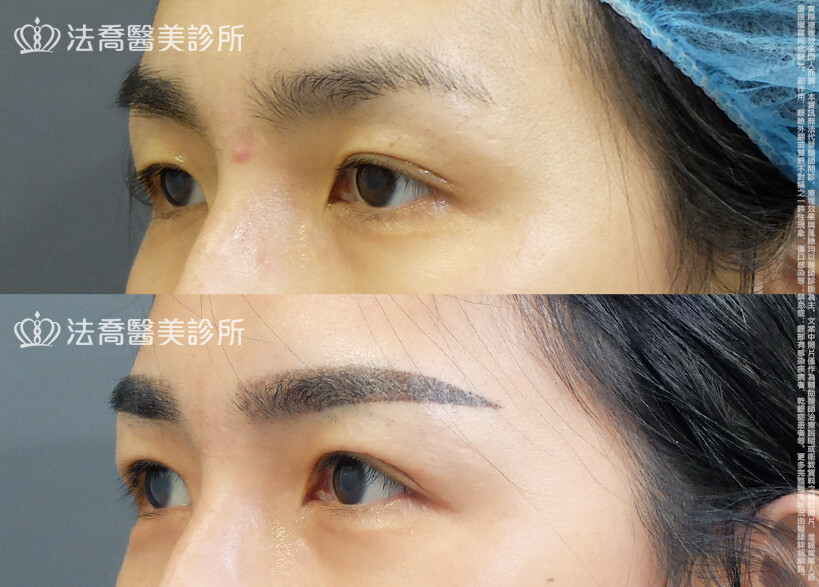 法喬醫美診所,邱浚彥,自體脂肪豐臉,割雙眼皮