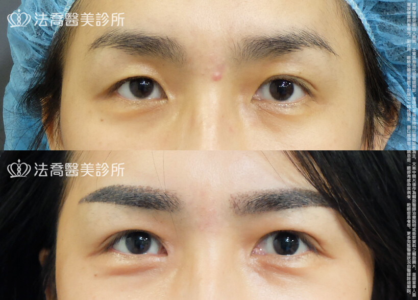 法喬醫美診所,邱浚彥,自體脂肪豐臉,割雙眼皮,眼窩補脂