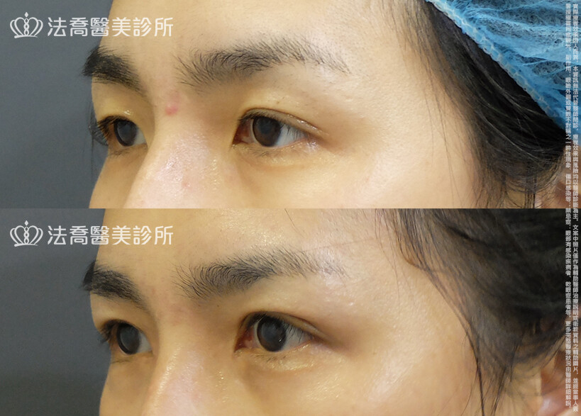 法喬醫美診所,邱浚彥,自體脂肪豐臉,割雙眼皮