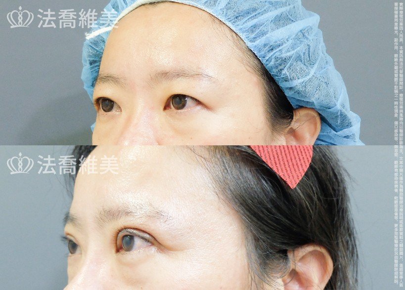 法喬醫美診所,邱浚彥,割雙眼皮