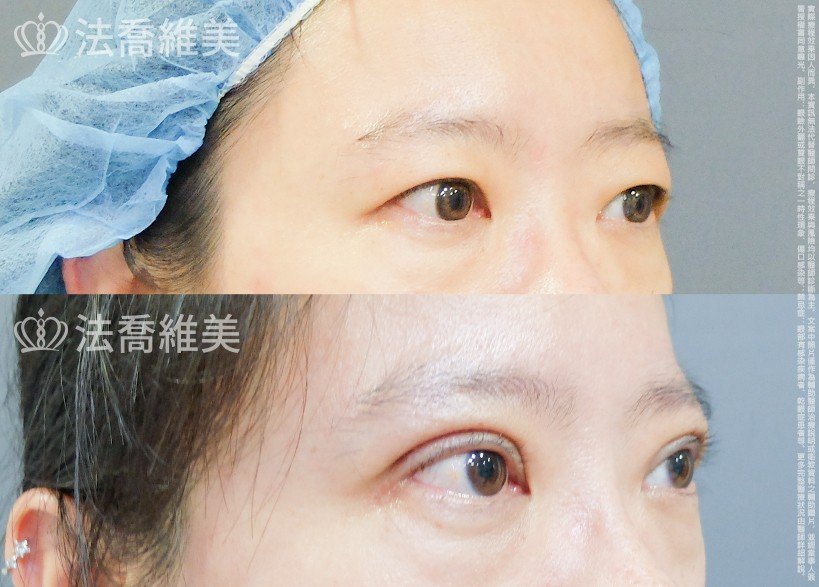 法喬醫美診所,邱浚彥,割雙眼皮