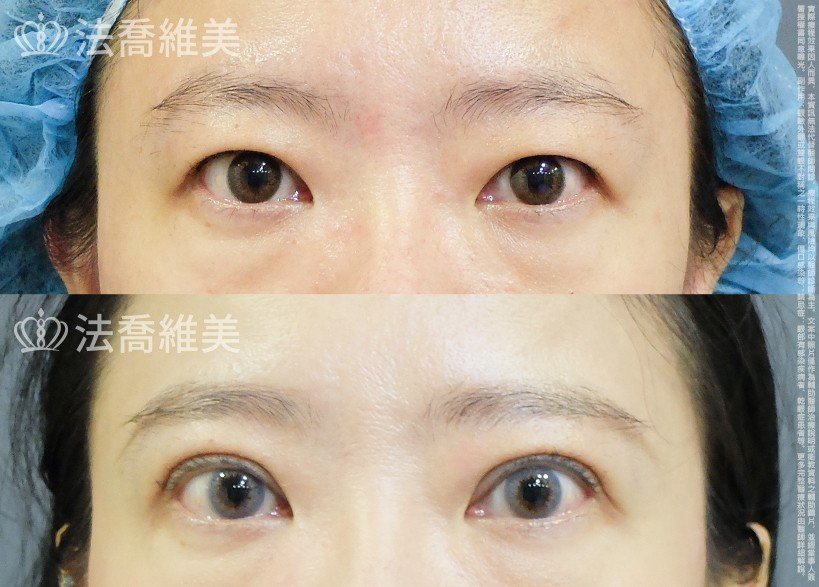 法喬醫美診所,邱浚彥,割雙眼皮