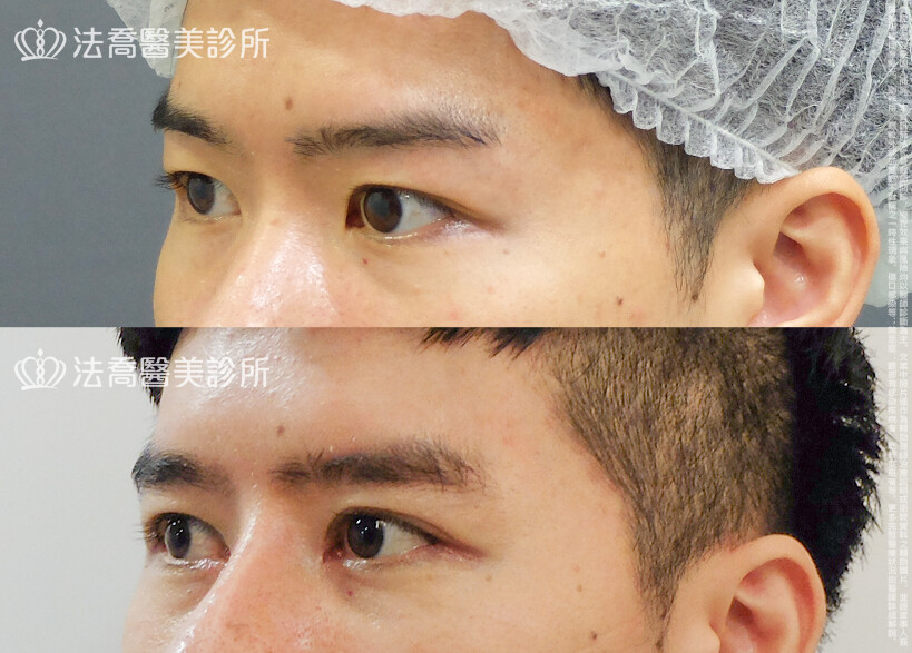法喬醫美診所,邱浚彥,割雙眼皮