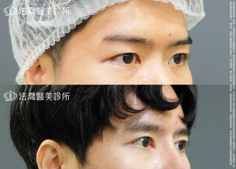 法喬醫美診所,邱浚彥,割雙眼皮
