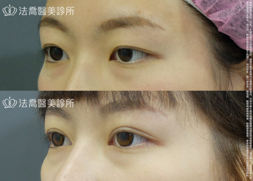 提眼瞼肌