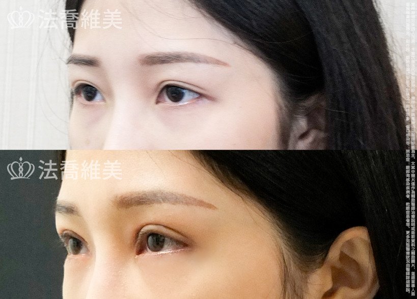 法喬醫美診所,邱浚彥,割雙眼皮,眼袋內開