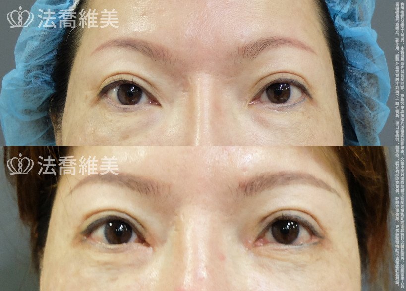 法喬醫美診所,邱浚彥,眼袋內開