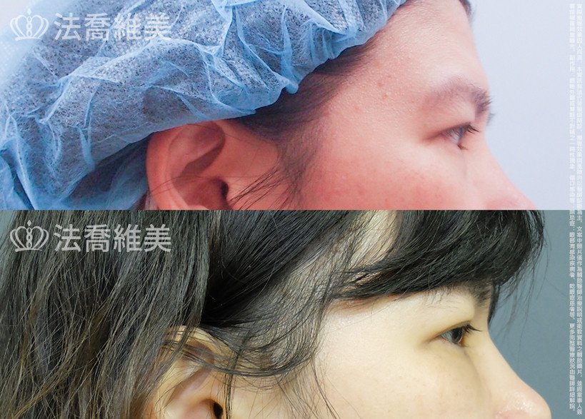 法喬醫美診所,邱浚彥,眼袋內開