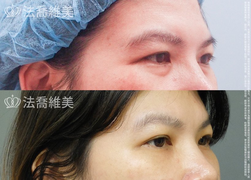 法喬醫美診所,邱浚彥,眼袋內開