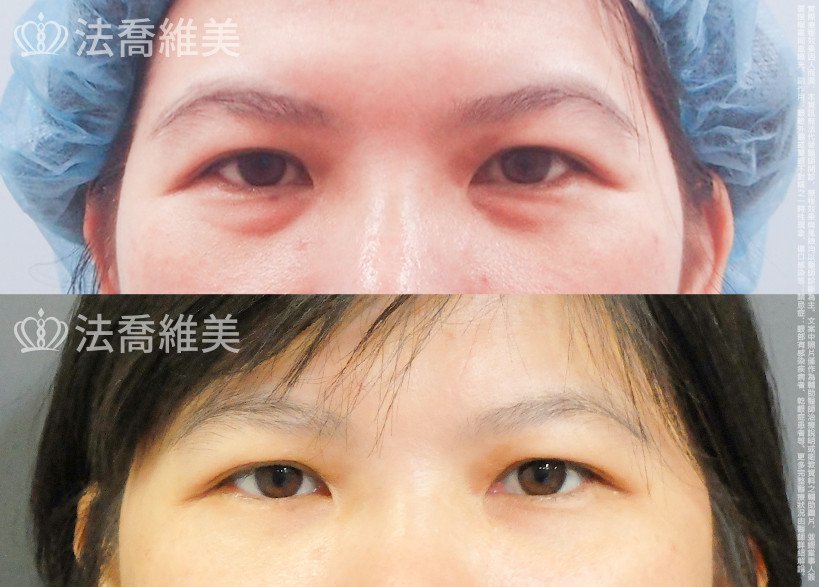 法喬醫美診所,邱浚彥,眼袋內開