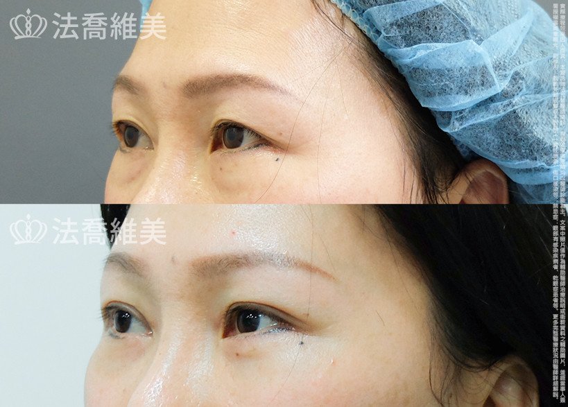 法喬醫美診所 邱浚彥醫師,眼袋內開