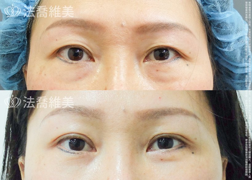 法喬醫美診所 邱浚彥醫師,眼袋內開