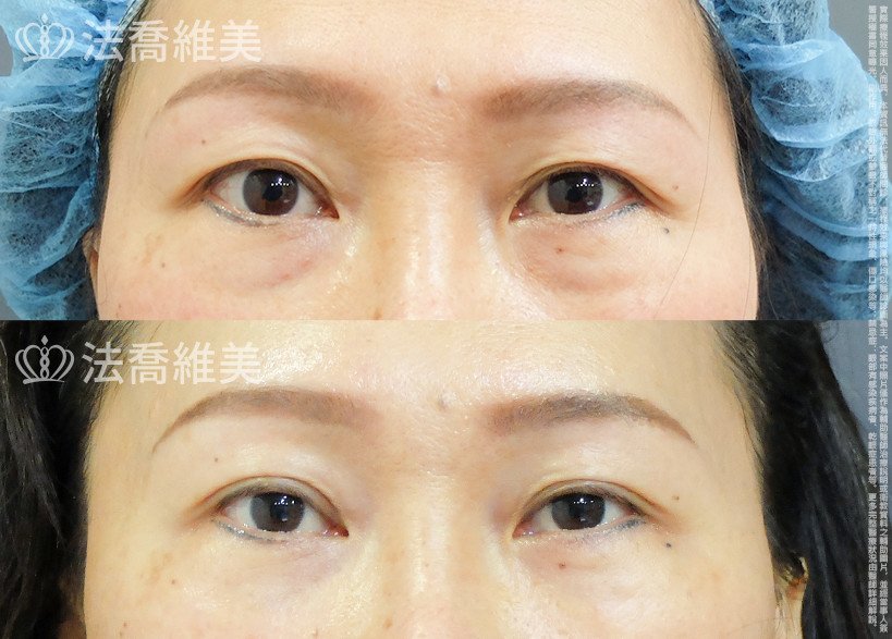法喬醫美診所 邱浚彥醫師,眼袋內開