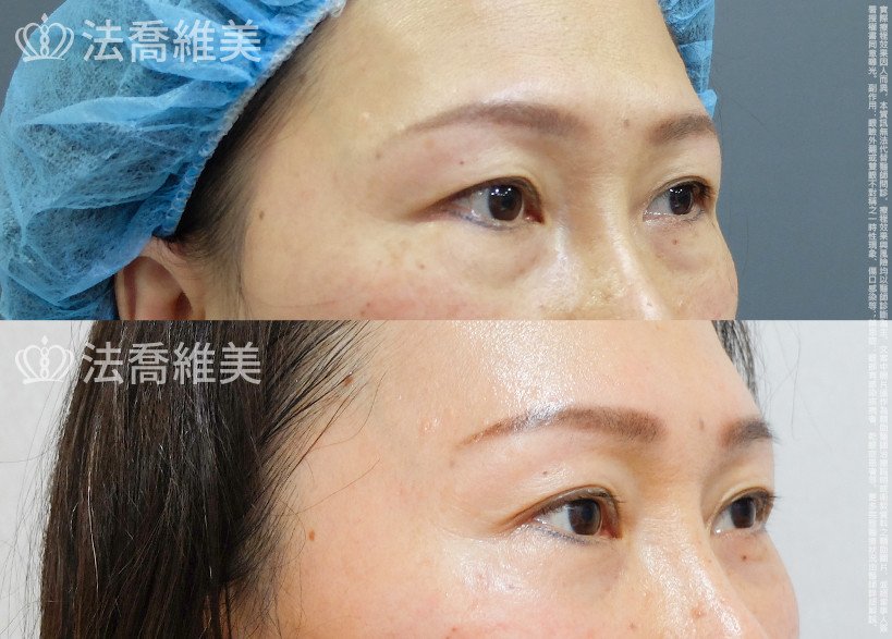 法喬醫美診所 邱浚彥醫師,眼袋內開