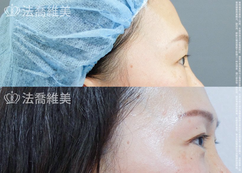 法喬醫美診所 邱浚彥醫師,眼袋內開