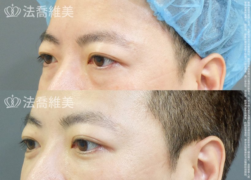法喬醫美診所 邱浚彥醫師,眼袋內開