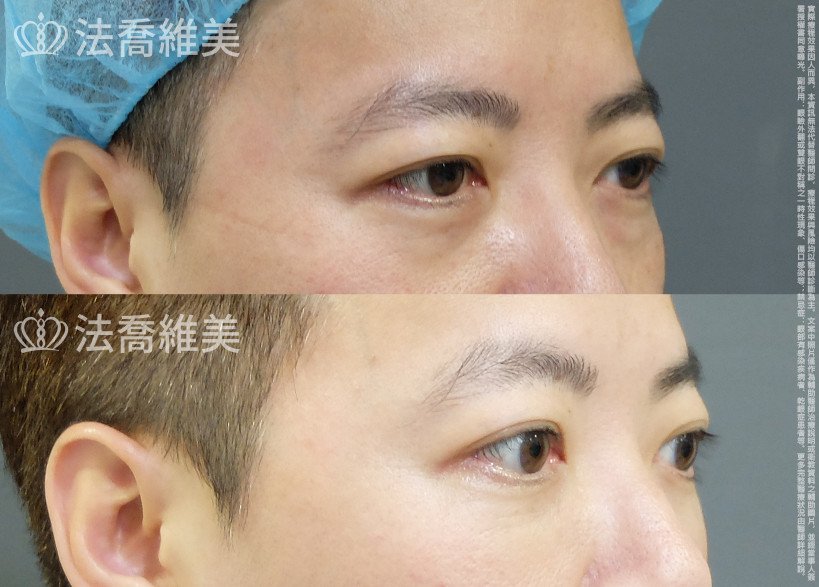 法喬醫美診所 邱浚彥醫師,眼袋內開