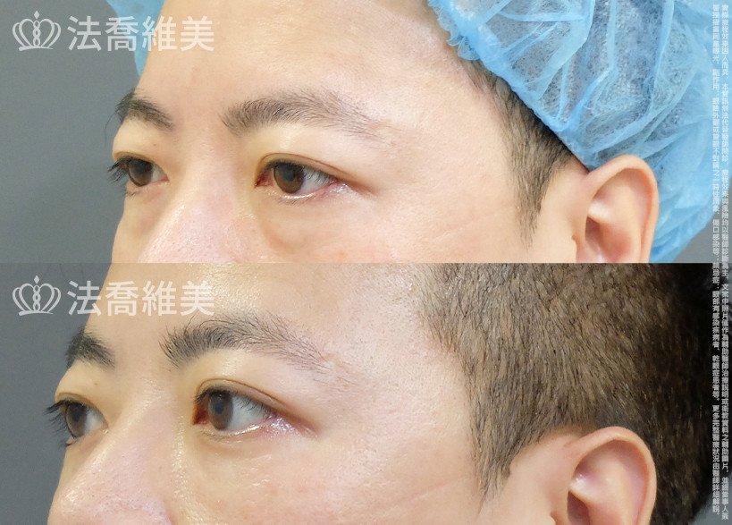 法喬醫美診所 邱浚彥醫師,眼袋內開