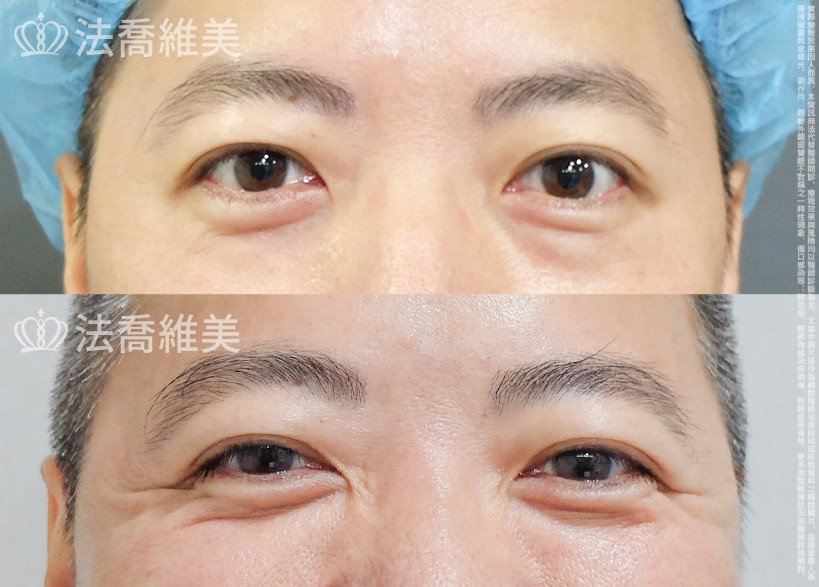 法喬醫美診所 邱浚彥醫師,眼袋內開