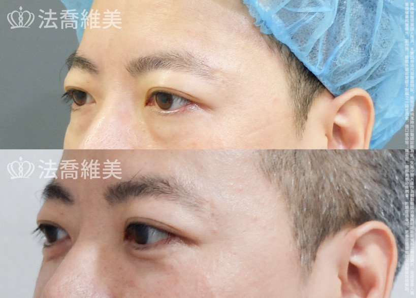法喬醫美診所 邱浚彥醫師,眼袋內開