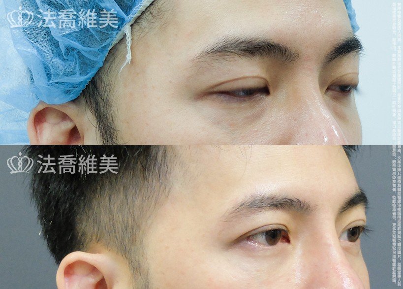 法喬醫美診所 邱浚彥醫師,眼袋內開