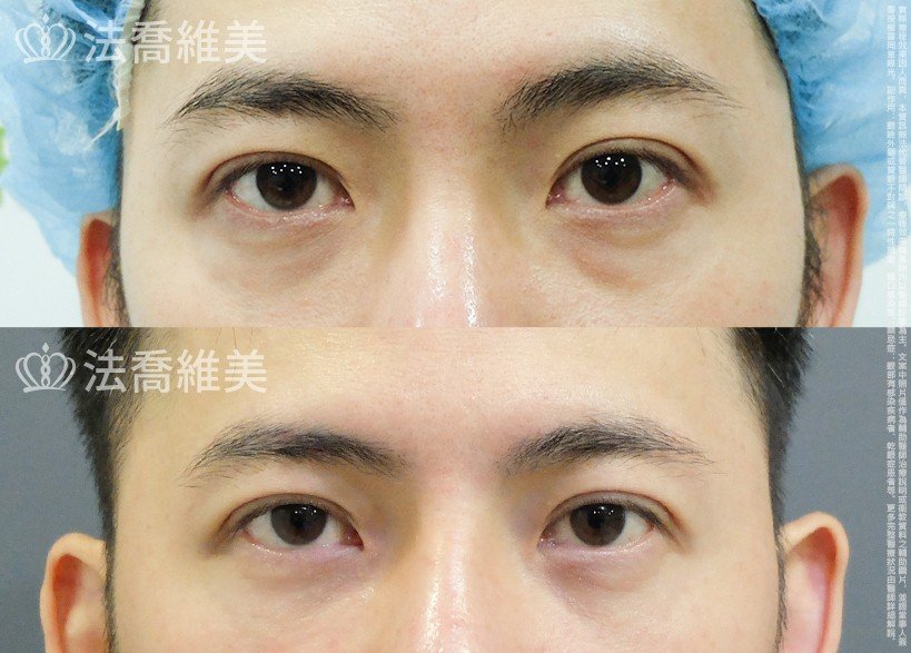 法喬醫美診所 邱浚彥醫師,眼袋內開