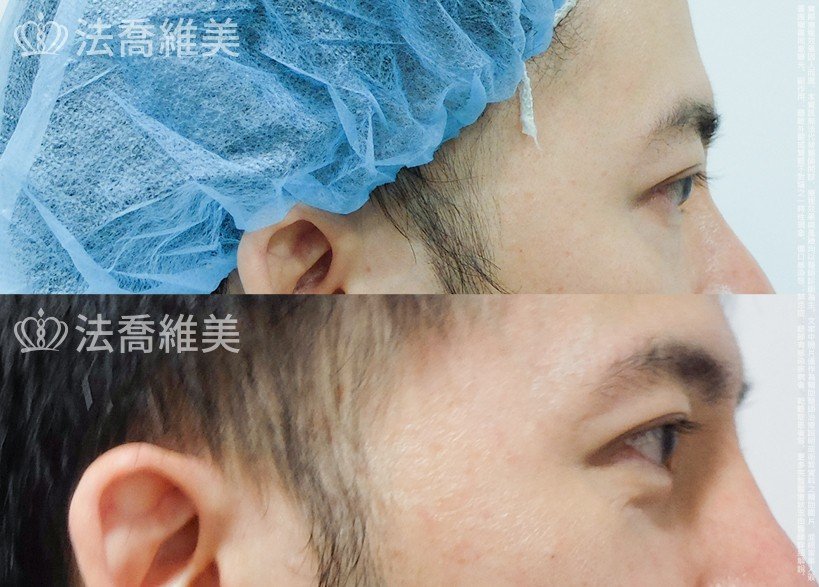 法喬醫美診所 邱浚彥醫師,眼袋內開