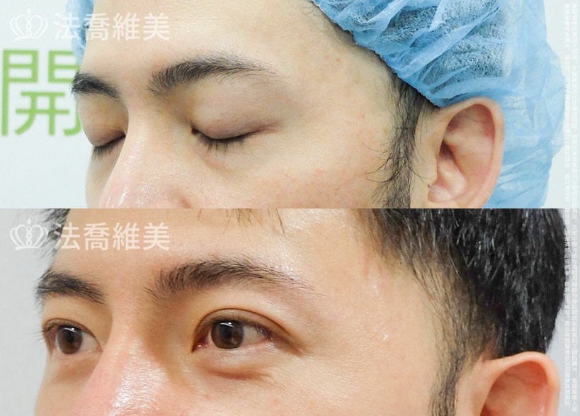 法喬醫美診所 邱浚彥醫師,眼袋內開