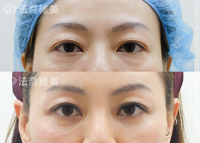 法喬醫美診所 邱浚彥醫師,眼袋內開