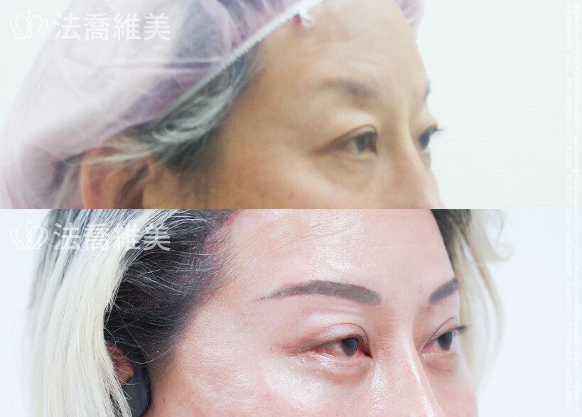 法喬醫美診所 邱浚彥醫師,眼袋內開