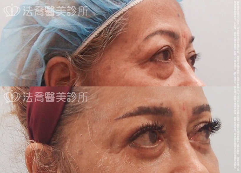 法喬醫美診所,邱浚彥,切眉