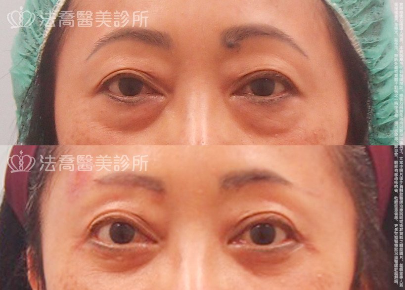 法喬醫美診所,邱浚彥,眼袋外開,切眉