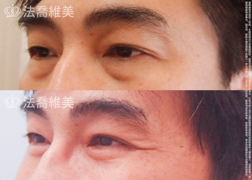 法喬醫美診所,邱浚彥醫師,眼袋外開