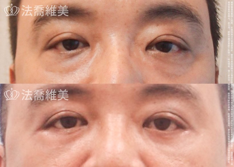 法喬醫美診所,邱浚彥醫師,眼袋外開