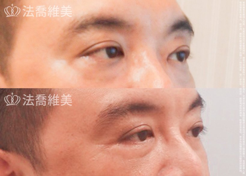 法喬醫美診所,邱浚彥醫師,眼袋外開