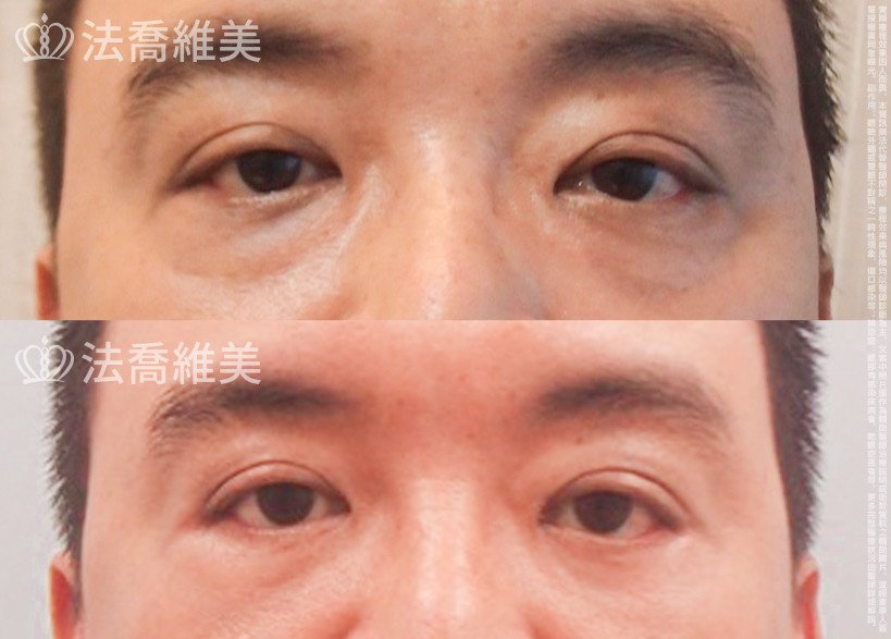 法喬醫美診所,邱浚彥醫師,眼袋外開