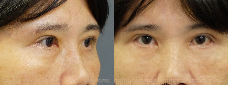 邱浚彥醫師眼袋案例_切眉+眼袋外開脂肪移位