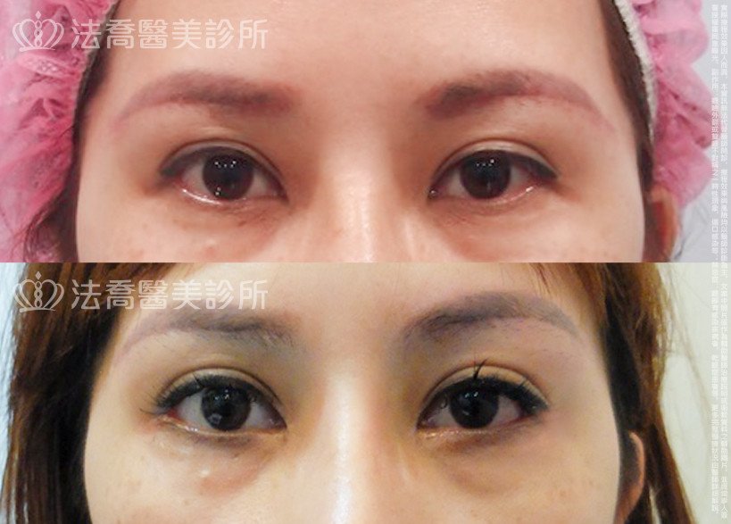 法喬醫美診所,邱浚彥,開眼頭,開眼尾