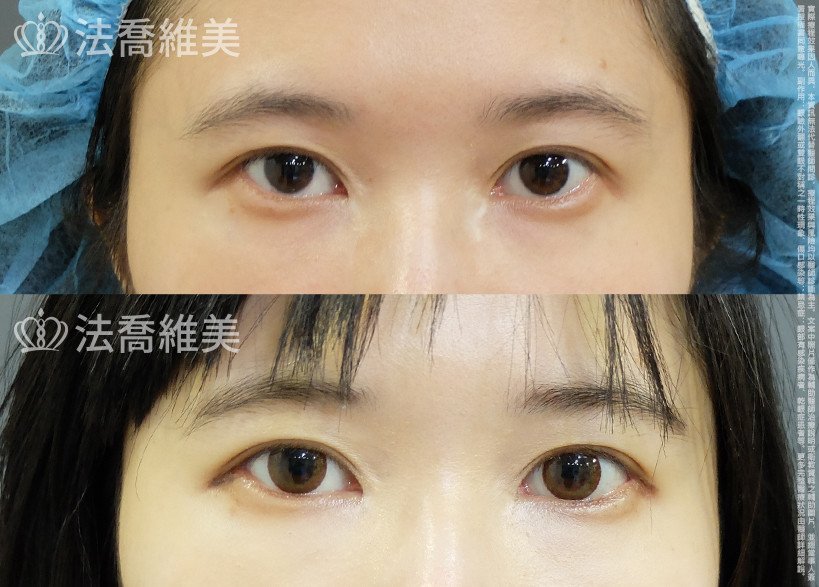 開眼尾,眼尾下置術,法喬醫美診所,邱浚彥