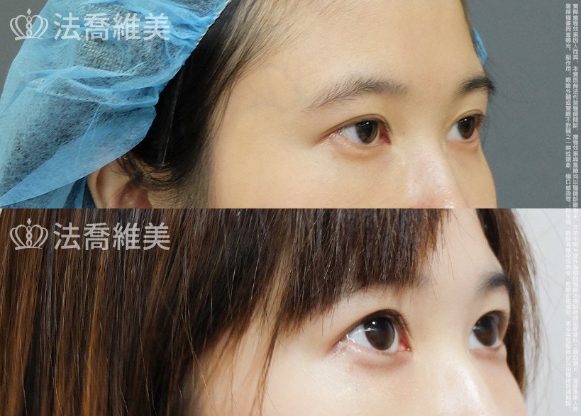 開眼尾,眼尾下置術,法喬醫美診所,邱浚彥