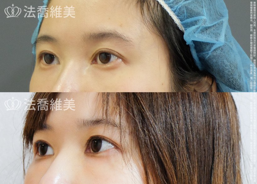 開眼尾,眼尾下置術,法喬醫美診所,邱浚彥