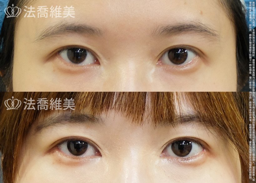 開眼尾,眼尾下置術,法喬醫美診所,邱浚彥