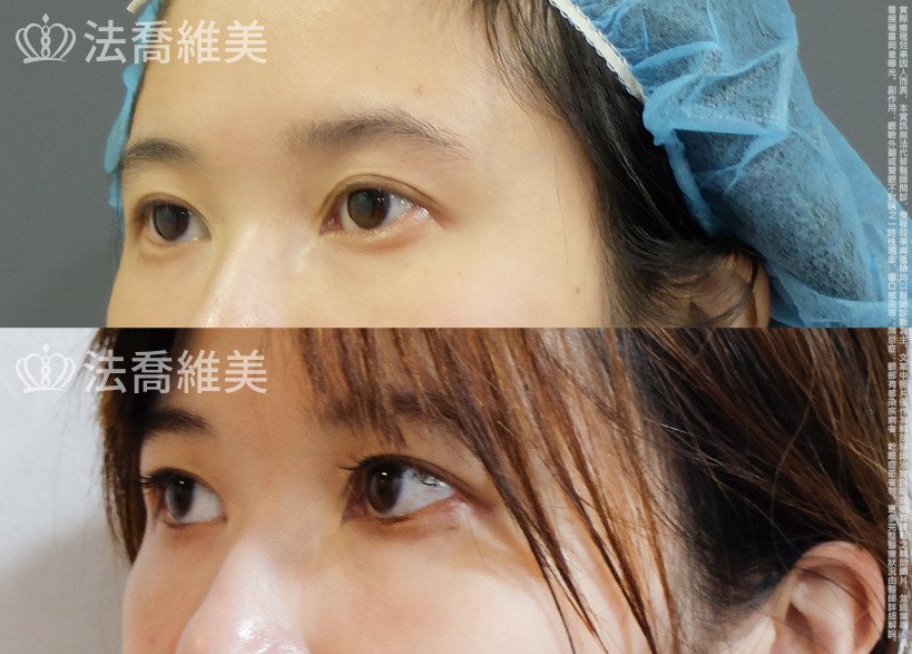 開眼尾,眼尾下置術,法喬醫美診所,邱浚彥