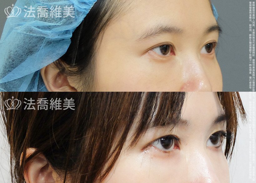 開眼尾,眼尾下置術,法喬醫美診所,邱浚彥